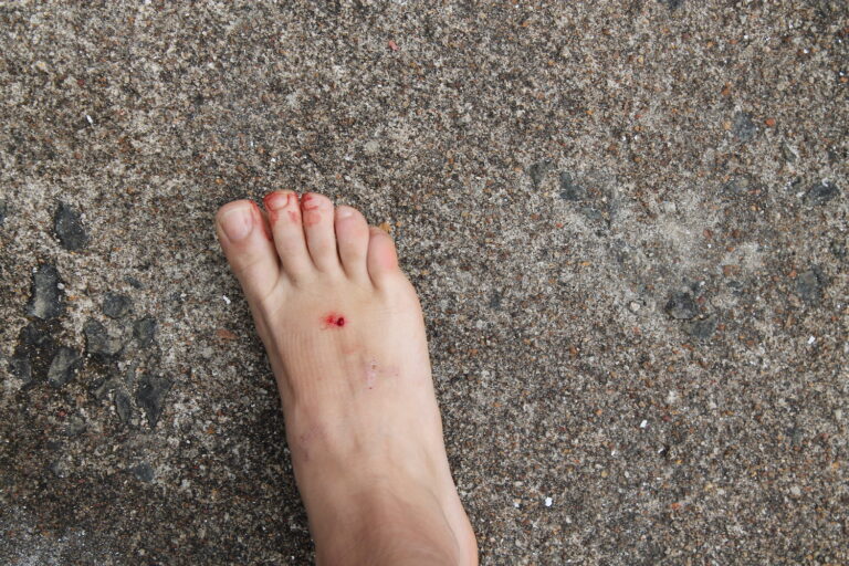 foot bleed from leeches
